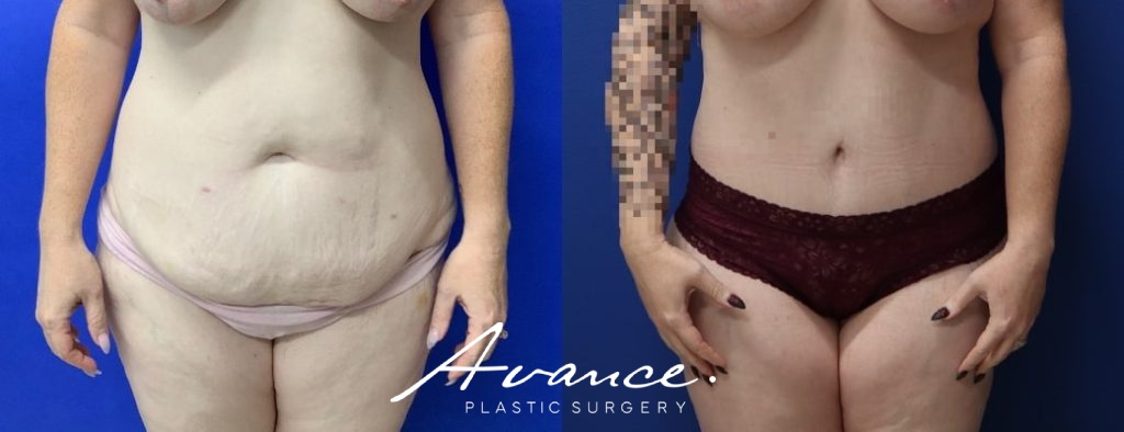 Before and After - Abdominoplasty