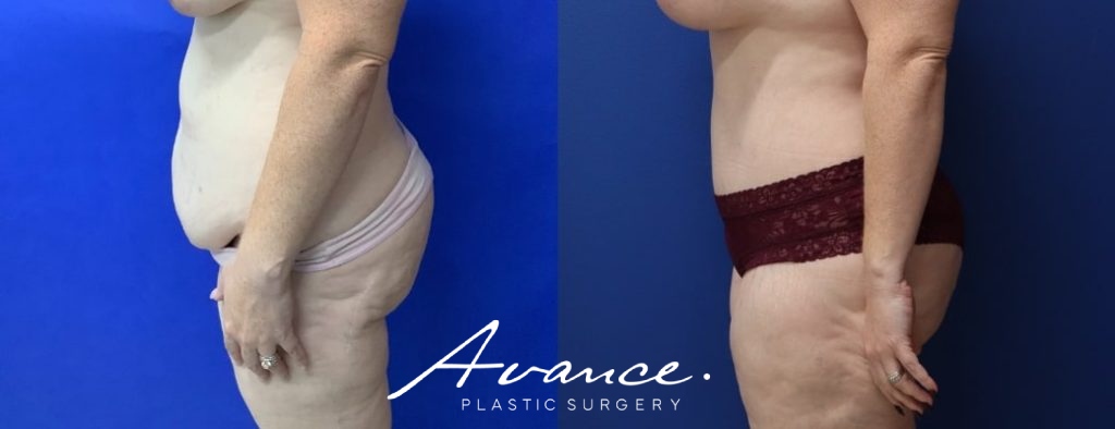 Before and After - Abdominoplasty