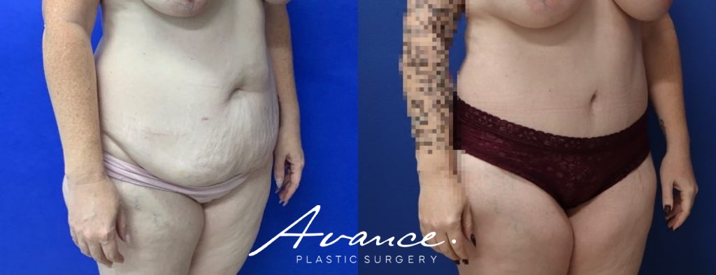 Before and After - Abdominoplasty