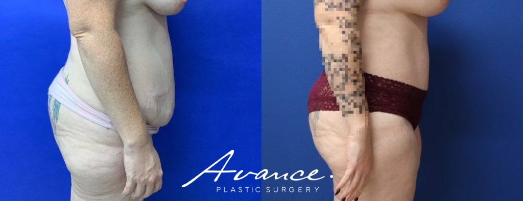 Before and After - Abdominoplasty