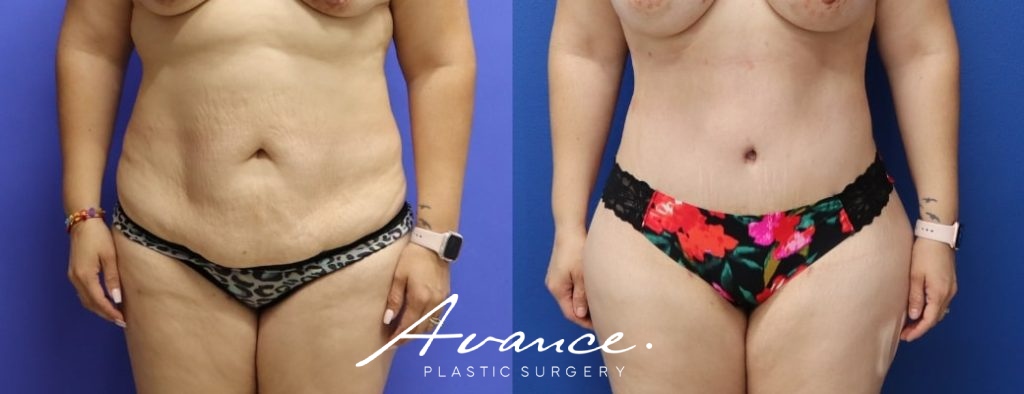 Before and After - Abdominoplasty