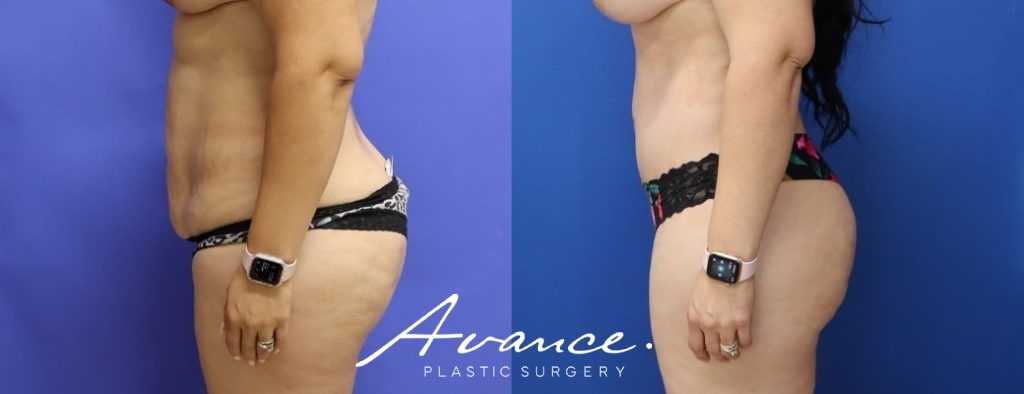 Before and After - Abdominoplasty