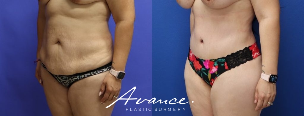 Before and After - Abdominoplasty