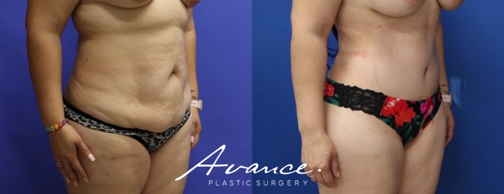 Before and After - Abdominoplasty