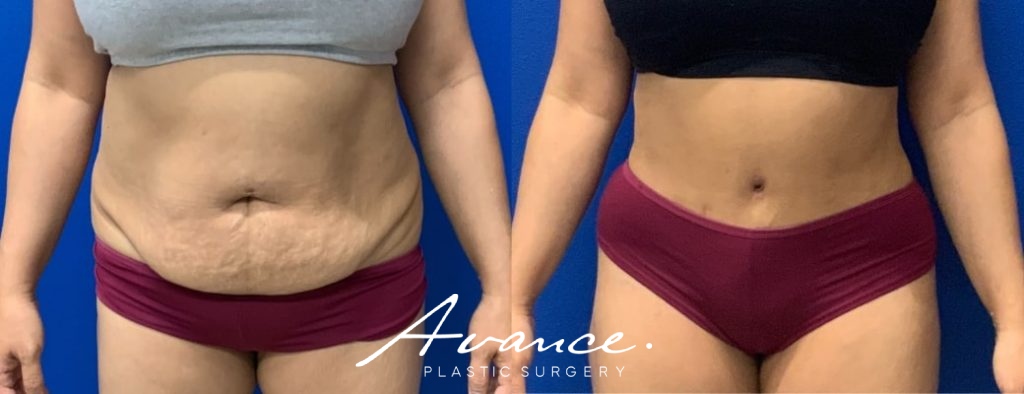 Before and After - Abdominoplasty