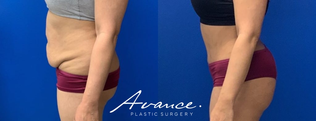 Before and After - Abdominoplasty