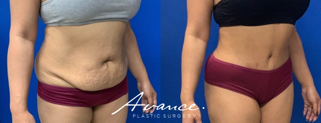 Before and After - Abdominoplasty