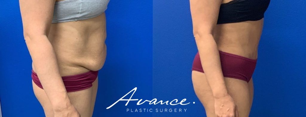 Before and After - Abdominoplasty