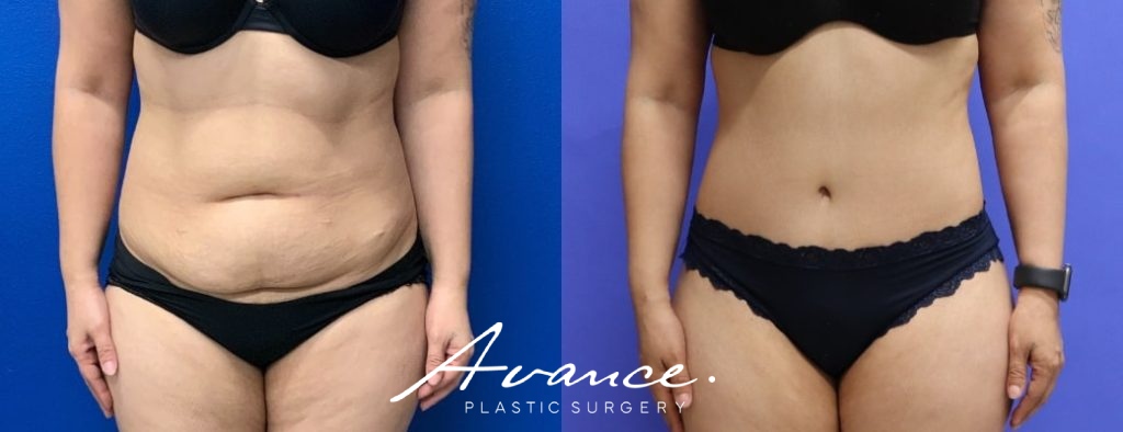Before and After - Abdominoplasty