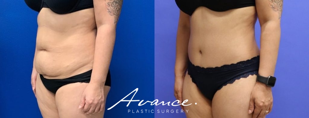 Before and After - Abdominoplasty
