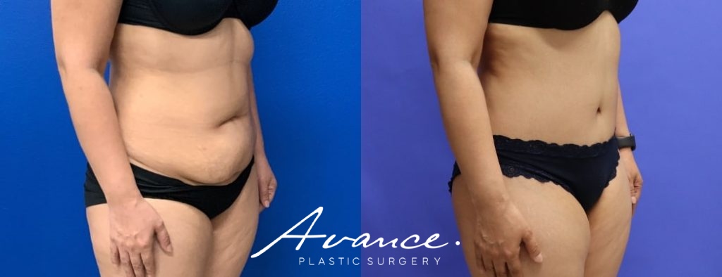 Before and After - Abdominoplasty