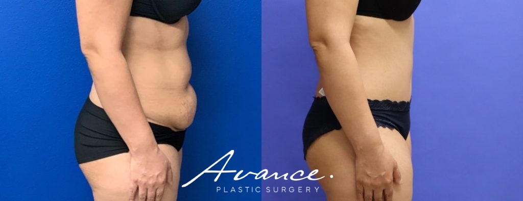 Before and After - Abdominoplasty