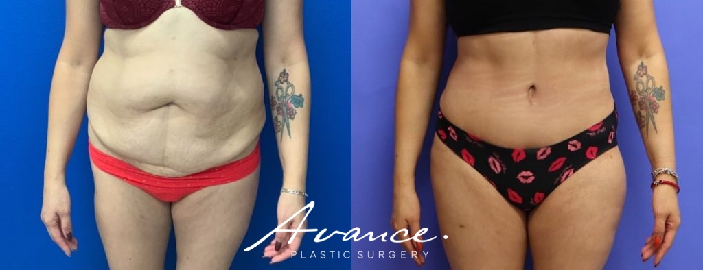 Before and After - Abdominoplasty