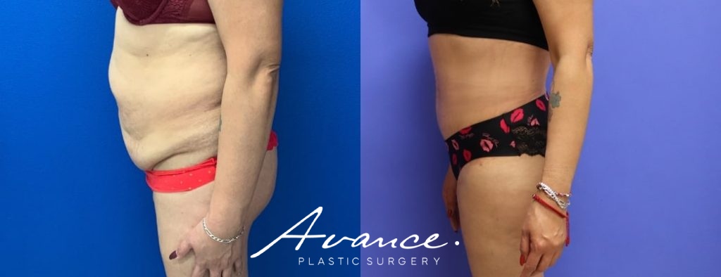 Before and After - Abdominoplasty