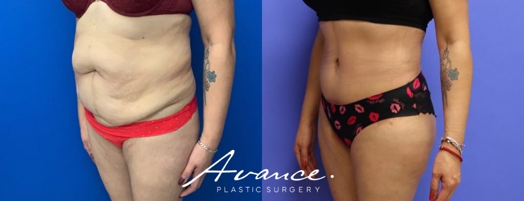 Before and After - Abdominoplasty