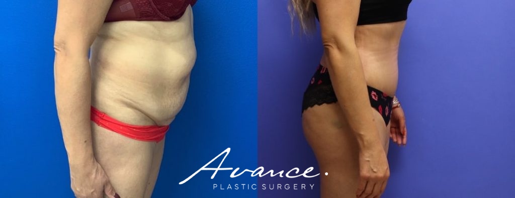 Before and After - Abdominoplasty