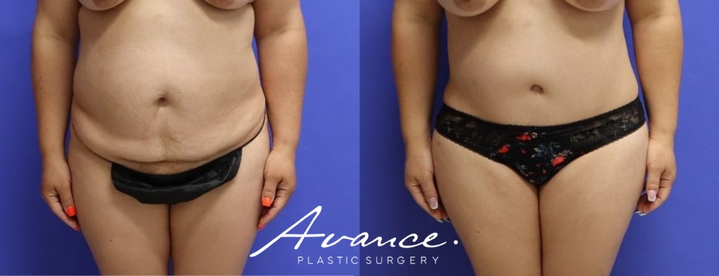 Before and After - Abdominoplasty