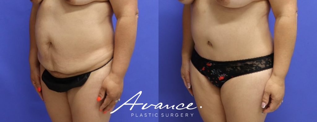 Before and After - Abdominoplasty