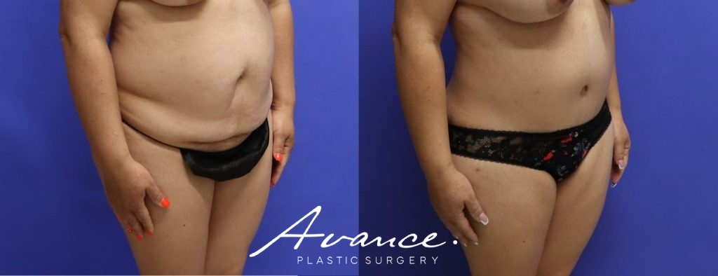 Before and After - Abdominoplasty