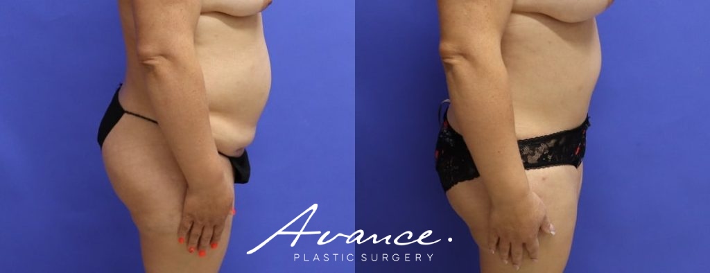 Before and After - Abdominoplasty