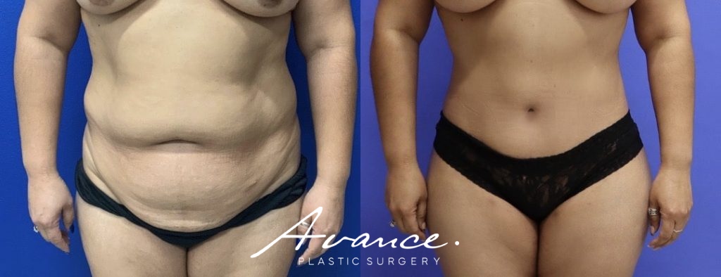 Before and After - Abdominoplasty