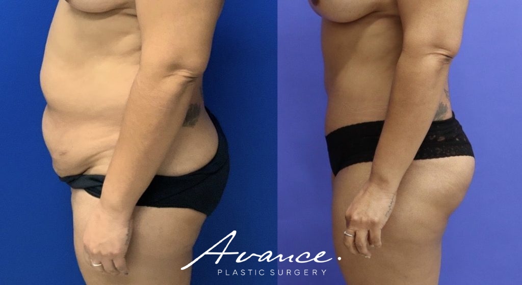 Before and After - Abdominoplasty