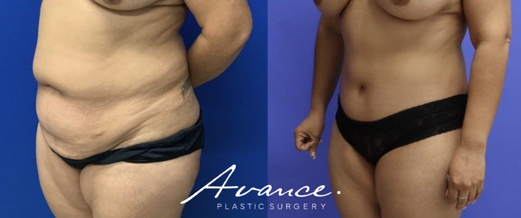 Before and After - Abdominoplasty