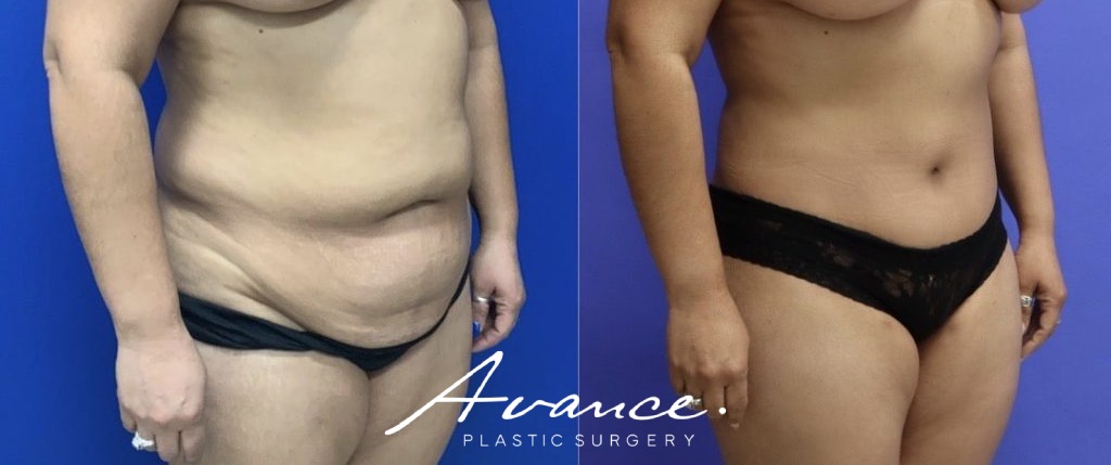 Before and After - Abdominoplasty
