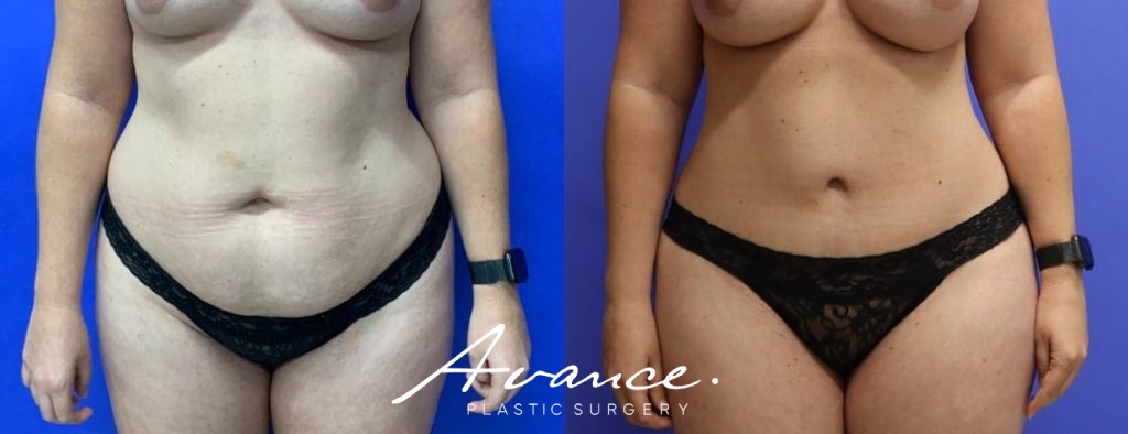Before and After - Abdominoplasty