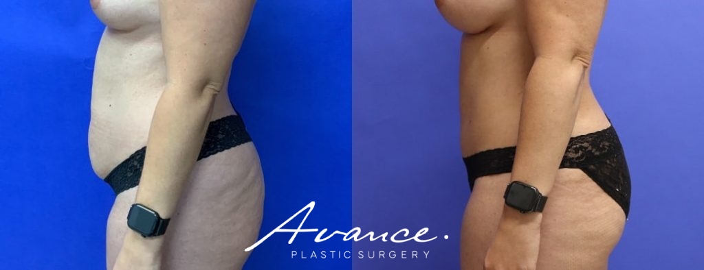 Before and After - Abdominoplasty