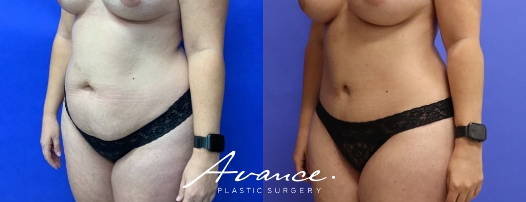 Before and After - Abdominoplasty
