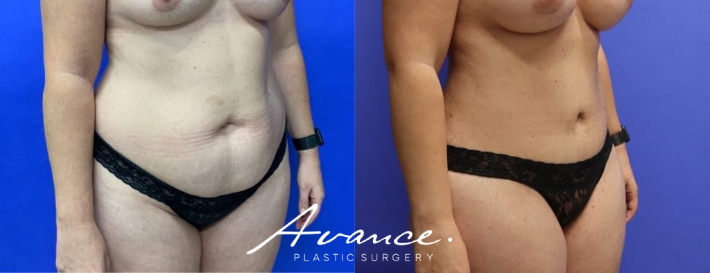 Before and After - Abdominoplasty