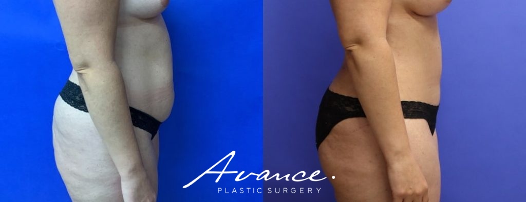 Before and After - Abdominoplasty