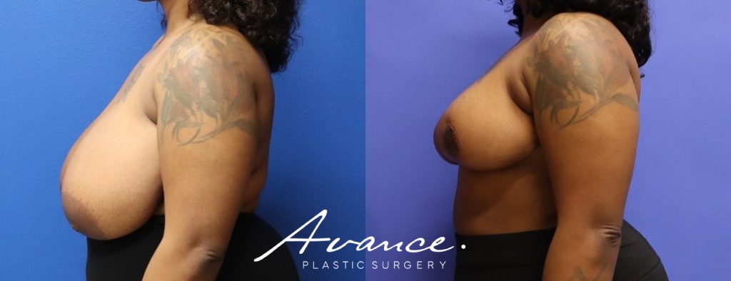 Before and After - Breast Reduction