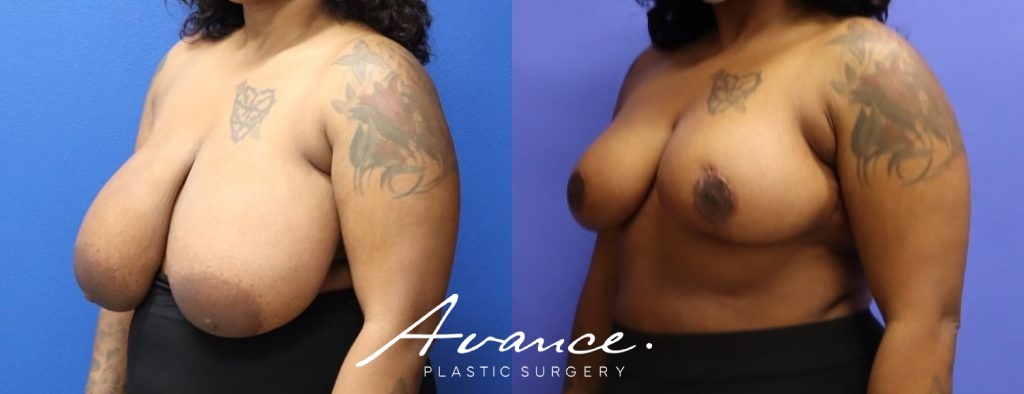 Before and After - Breast Reduction