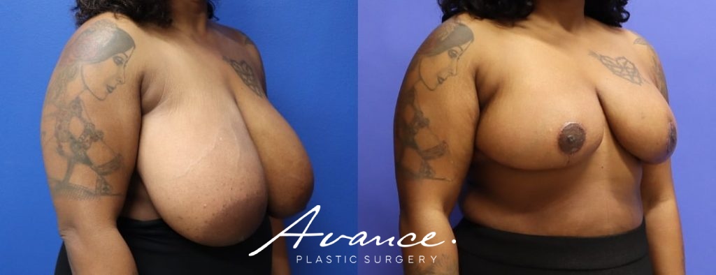 Before and After - Breast Reduction