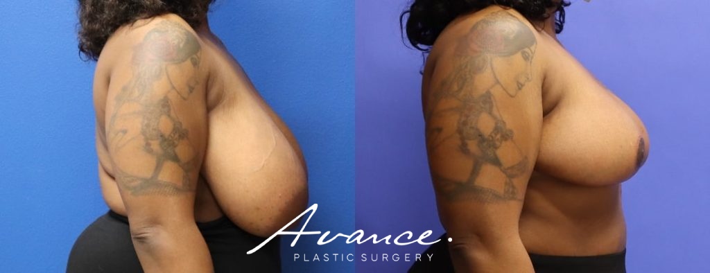 Before and After - Breast Reduction