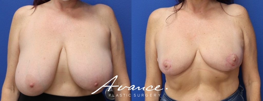 Before and After - Breast Reduction