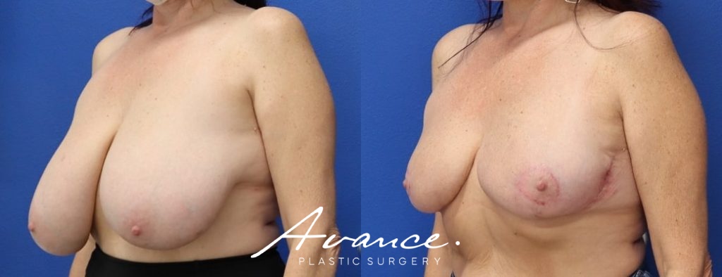 Before and After - Breast Reduction