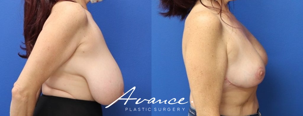 Before and After - Breast Reduction