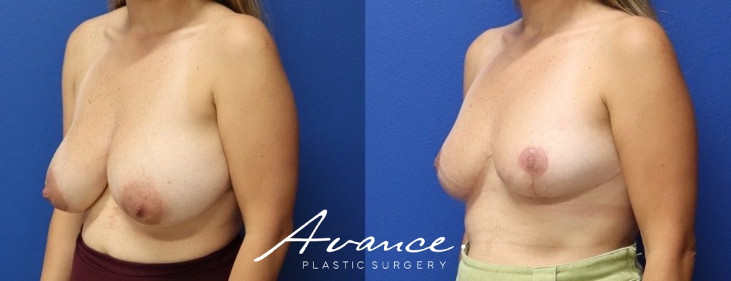 Before and After - Breast Reduction