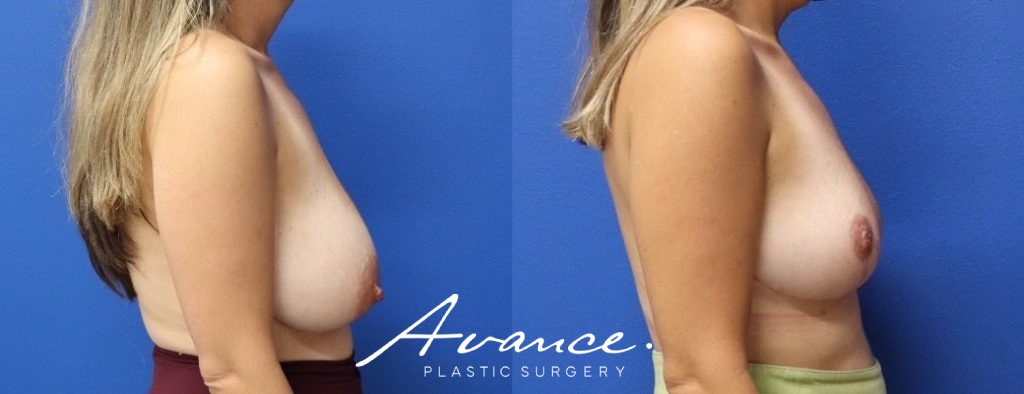 Before and After - Breast Reduction