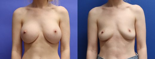 Before and After - Breast Implant Removal
