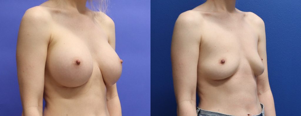 Before and After - Breast Implant Removal