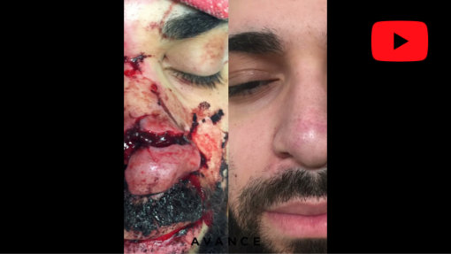 YouTube video titled Reno Facial Trauma Reconstruction | Nose/Nasal Reconstruction Lake Tahoe | Avance Plastic Surgery