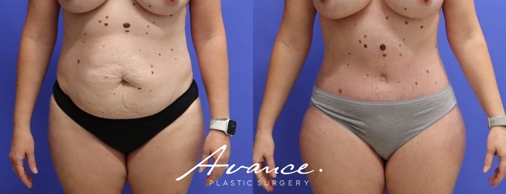 Before and After - Abdominoplasty