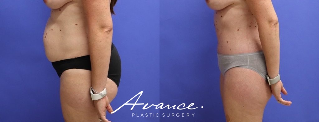 Before and After - Abdominoplasty