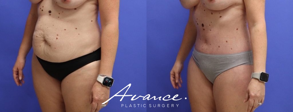 Before and After - Abdominoplasty