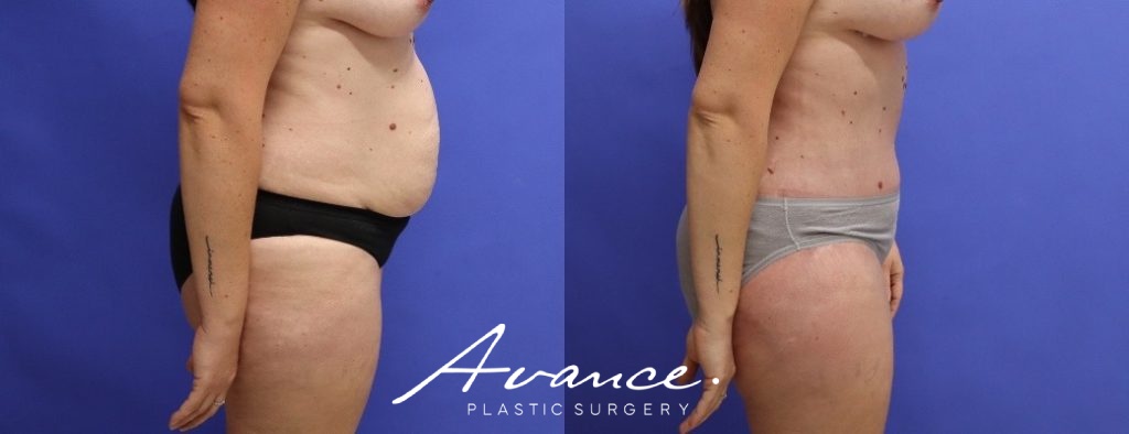 Before and After - Abdominoplasty