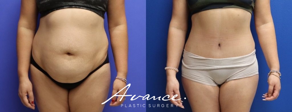 Before and After - Abdominoplasty